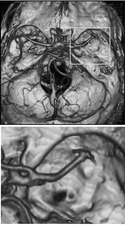 Three Dimensional Computed Tomography Angiography Demonstrated Download Scientific Diagram