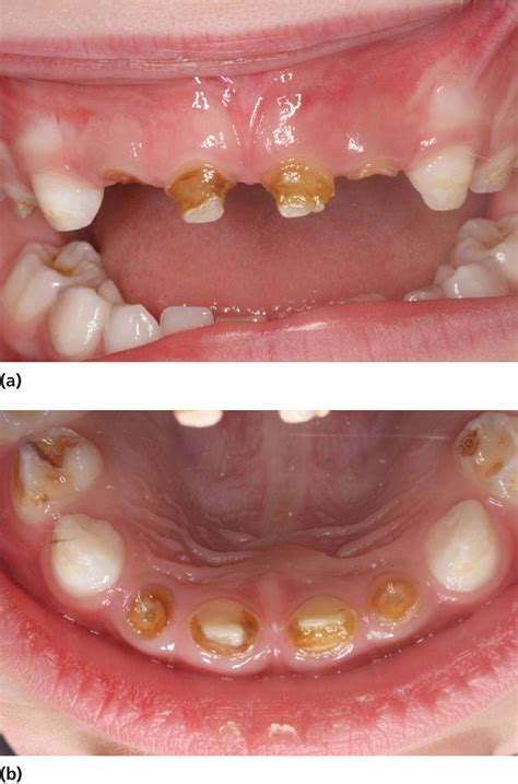 Diagnosis And Management Of Dental Caries Pediatric Dentistry A