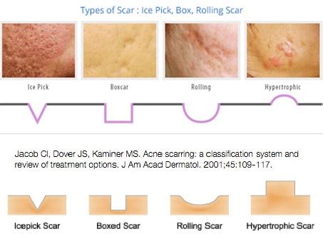 What Is Acne Scar And Large Pores The Aesthetic Studio Singapore