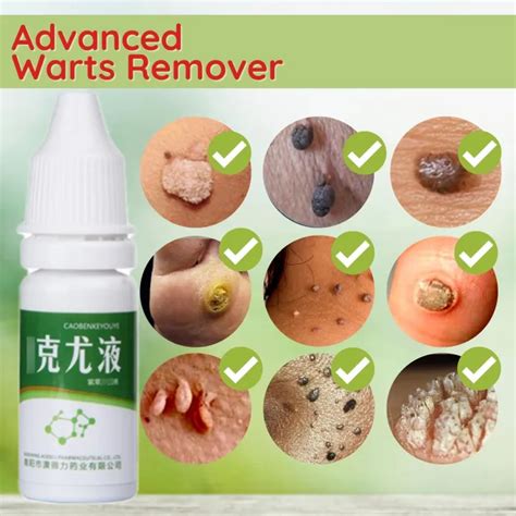 Kasoy Oil Warts Remover Original Cream Removal Warts And Skin Tags