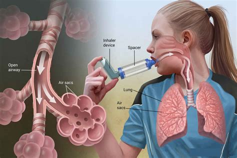 Status Asthmaticus Definition Causes Symptoms Diagnosis And Treatment