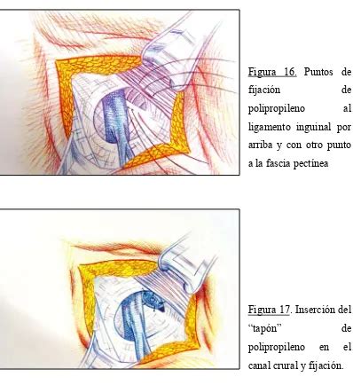 Justificaci N De La Tesis Diagn Stico Diferencial De Hernia Lipomas