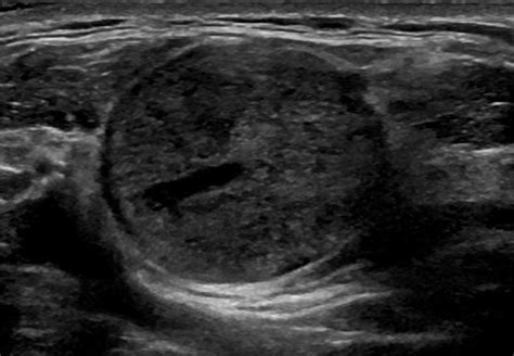 An ultrasound image of the well-circumscribed 22 × 22 × 25 mm round ...