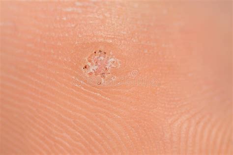 Plantar Wart On Big Toe Visible Black Dots Warts Stock Image Image