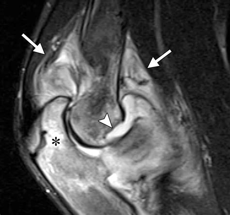 Imaging Of Juvenile Idiopathic Arthritis A Multimodality Approach Radiographics