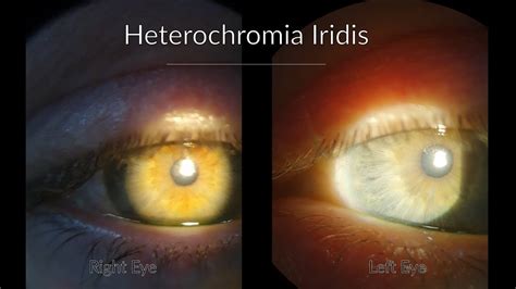 Fuchs Heterochromic Iridocyclitis