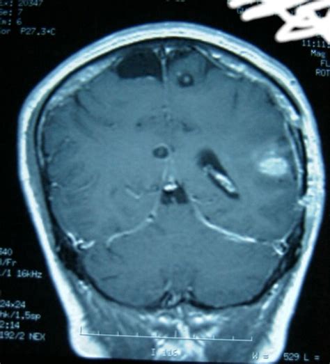 Patologia Neurocisticercosis