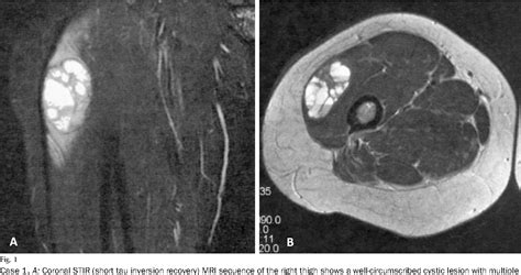 Aneurysmal Bone Cyst Mri