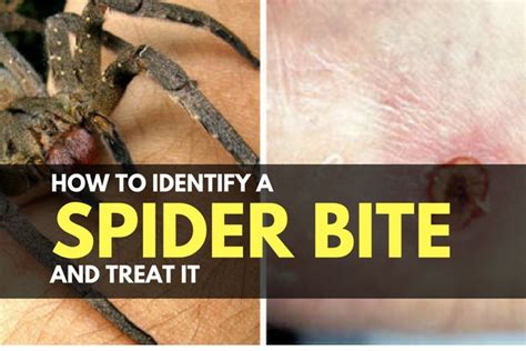 How to Identify a Spider Bite and Treat It | TruePrepper