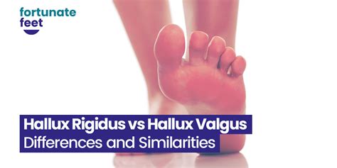 Hallux Rigidus Vs Hallux Valgus Differences And Similarities Fortunate Feet