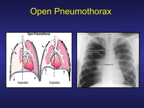 Treating Penetrating Chest Trauma PPT