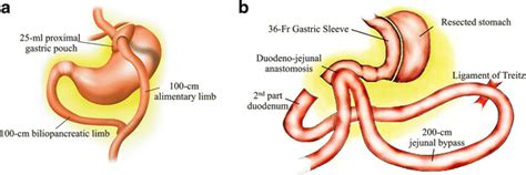 Surgical Techniques Of Roux En Y Gastric Bypass A And Loop