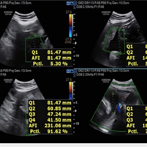 Usg Image Showing Afi At 34 Weeks Of Gestation For The First Patient