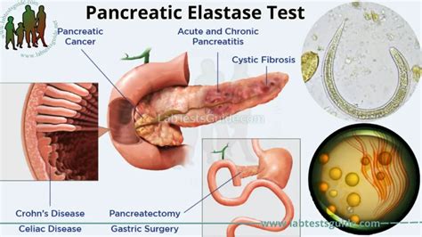 Pancreatic Elastase Test: Purpose, Procedure, and Results - Everything ...