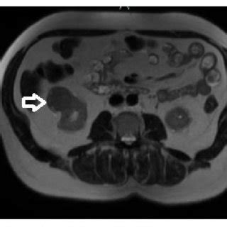 MRI of the abdomen displaying round exophytic mass of the right kidney ...