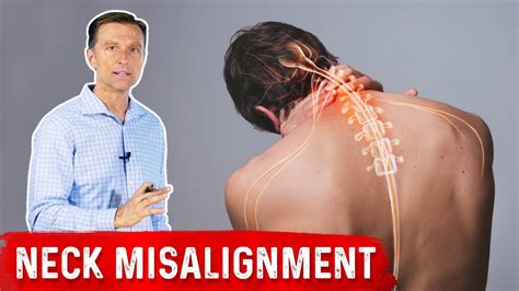 Chronic Neck Misalignment Does Not Come From The Neck Youtube