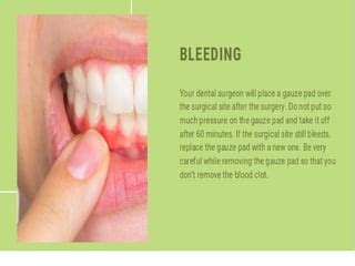 Recovery After Dental Implant Surgery | PPT