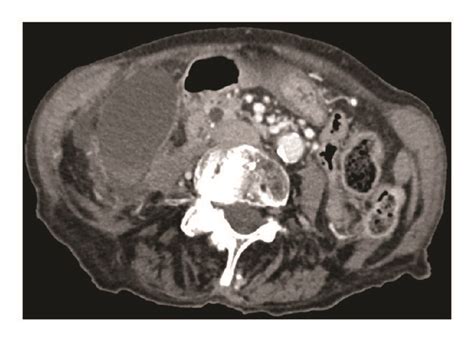 Abdominal Contrast Enhanced Ct Scan Portal Phase Distended Gallbladder Download Scientific