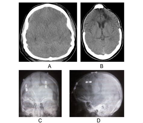 Ct Scan Sequence Images Of A Patient With Bifrontal Dc A Pre Surgical