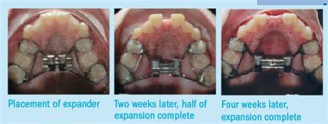 RPE (Palatal Expansion) - Smile Design & Beyond, Los Angeles Orthodontist