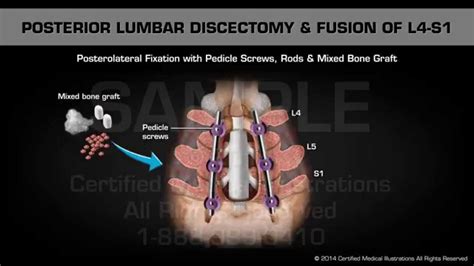 Lumbar Discectomy Surgery