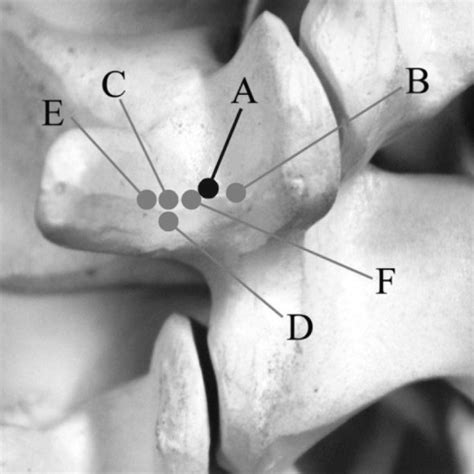 Reconstructive Image Of The Entry Point Of Pedicle Screw Download Scientific Diagram