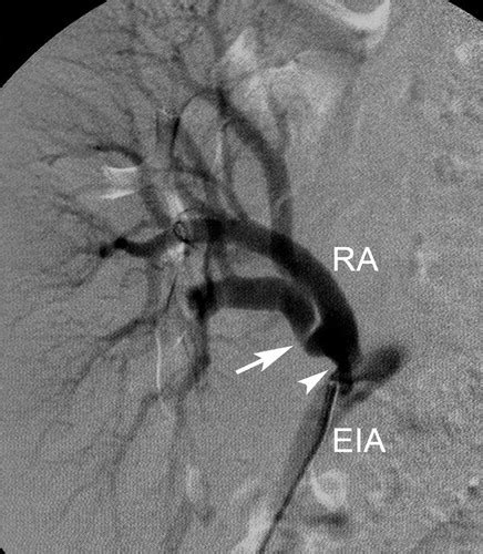 Renal Transplant Nonenhanced Renal Mr Angiography With Magnetization