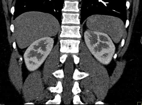 Bilateral Acute Pyelonephritis Kidney Case Studies Ctisus Ct Scanning