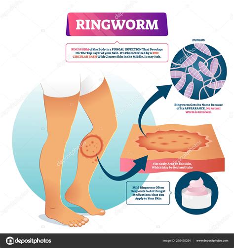 Ringworm vector illustration. Labeled fungal skin infection example