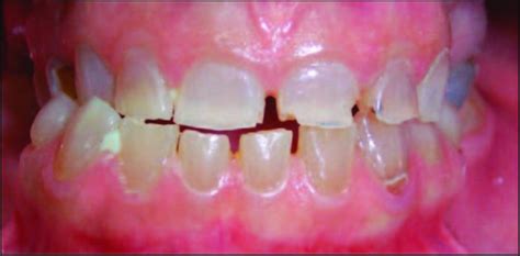 Dentinogénesis imperfecta tipo II. | Download Scientific Diagram