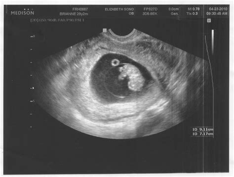 Baby Ultrasound: Baby Ultrasound By Week