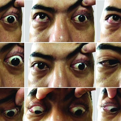 Nine gazes of patient showing left eye proptosis with total ...