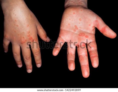 Child Red Rash Coxsackievirus On Both Stock Photo 1422492899 | Shutterstock