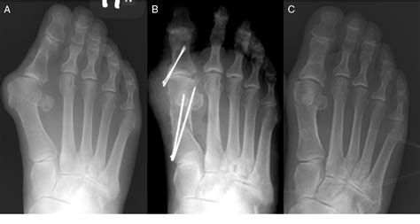 Great Toe Proximal Phalanx Fracture