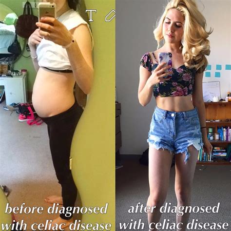 Celiac Disease Before And After Photos Ps Fitness