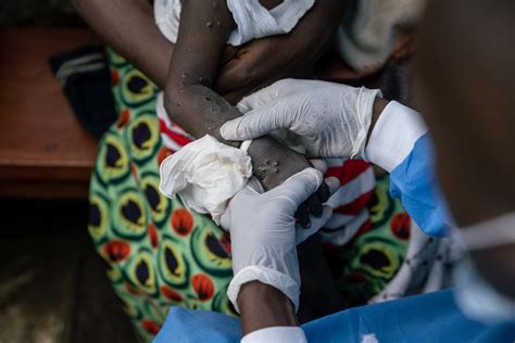 Fast Spreading Clade Ib Mpox Found In Congo Capital With Over