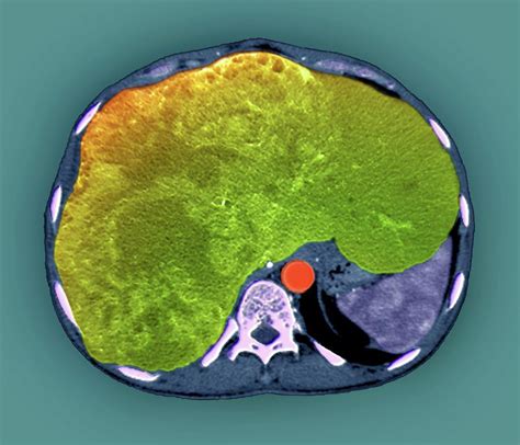 Liver Cancer By Zephyr Science Photo Library