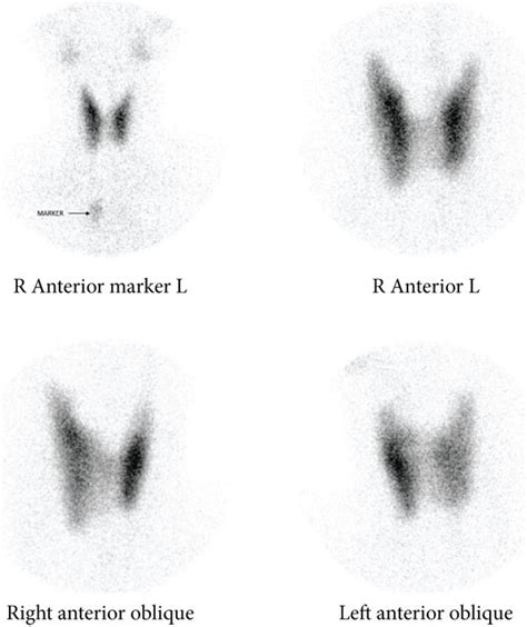 Tc 99 M Pertechnetate Thyroid Scintigraphy Thyroid Scan Showing