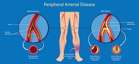 Peripheral Vascular Disease Treatment Pad Treatment