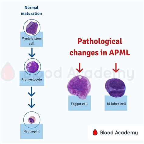 Promyelocyte