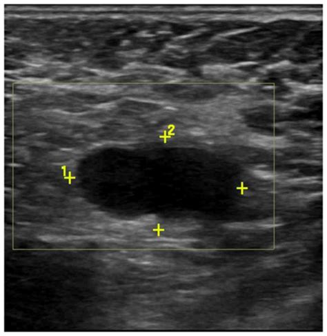 Axillary Lymph Nodes Ultrasound