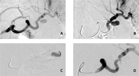 Figure 3 From Endovascular Treatment Of Visceral Artery Aneurysms A