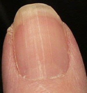 Vertical Lines On Nails Vitamin Deficiency Sanscompro Misaucun