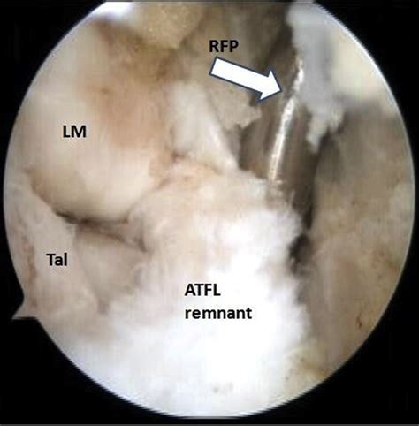 Arthroscopic Anatomic Anterior Talofibular Ligament Repair For