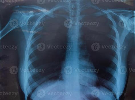 Woman Xray For Chest And Lungs Examination Stock Photo At Vecteezy