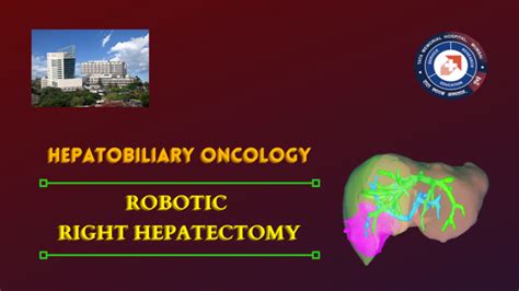 Pdf Robotic Right Hepatectomy Using The Modified Rubber Band