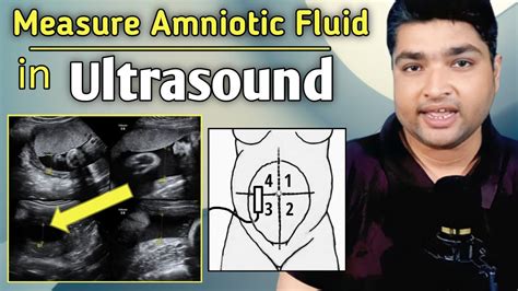 How To Measure Amniotic Fluid Index By Ultrasound Amniotic Fluid