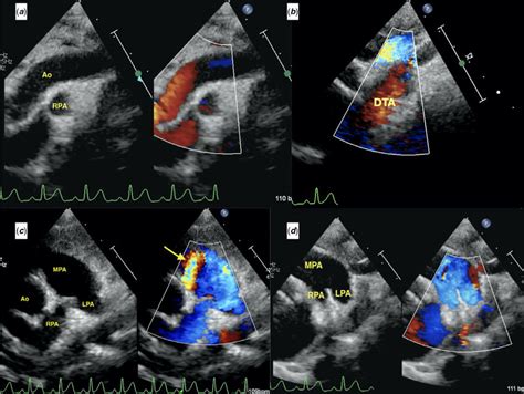 Echocardiographic Images In Suprasternal View A And B Showing An