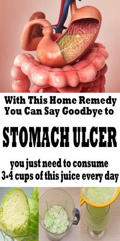 Stomach Ulcers Causes Symptoms Home Remedies Treatment – NBKomputer