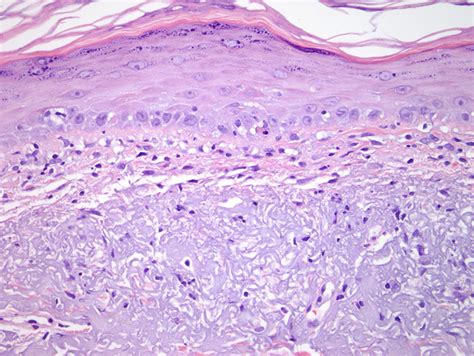 Subacute Cutaneous Lupus Erythematosus | Dermatopathology